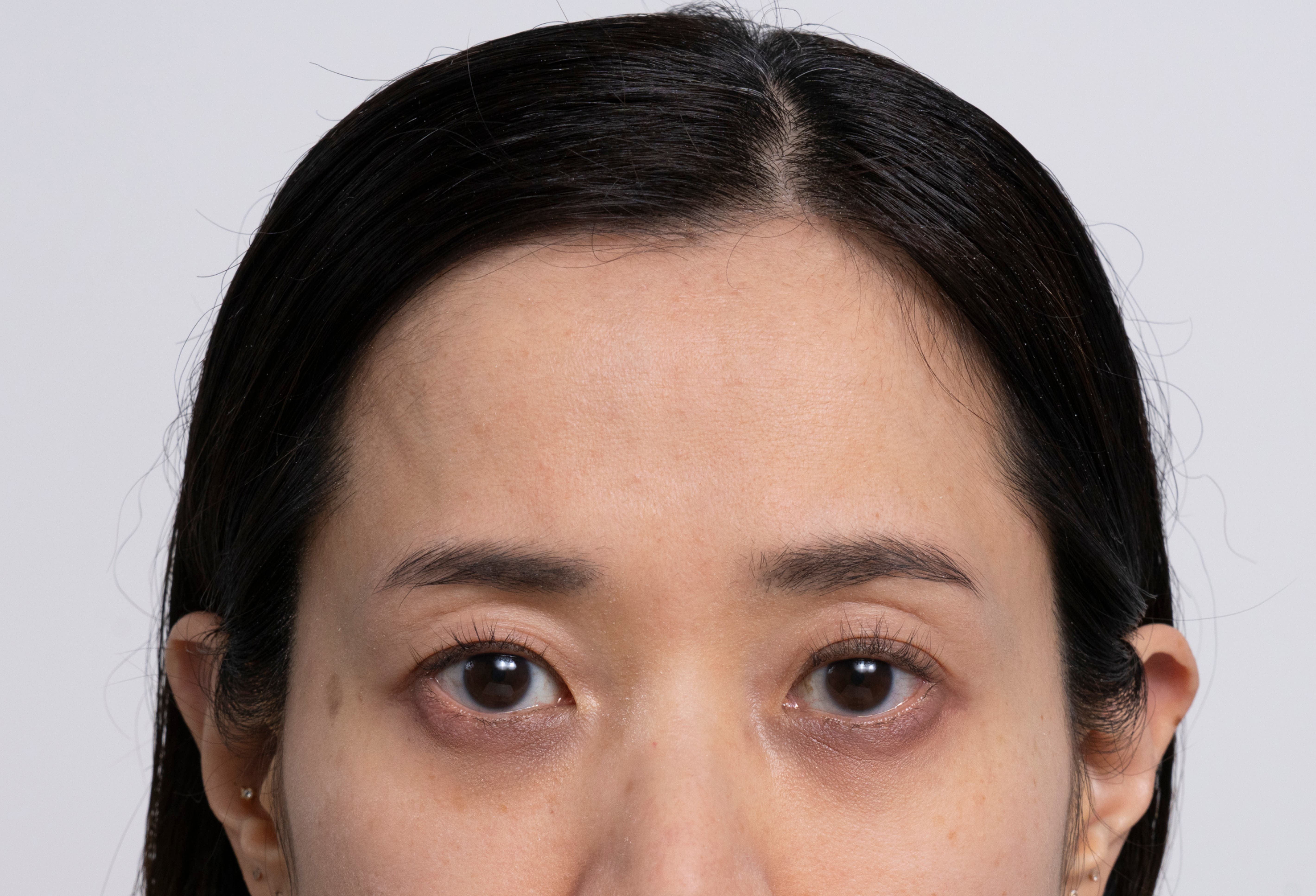 Gedeeltelijk portret van een vrouw met een glad voorhoofd, een heldere huid en lichte donkere kringen onder haar ogen.