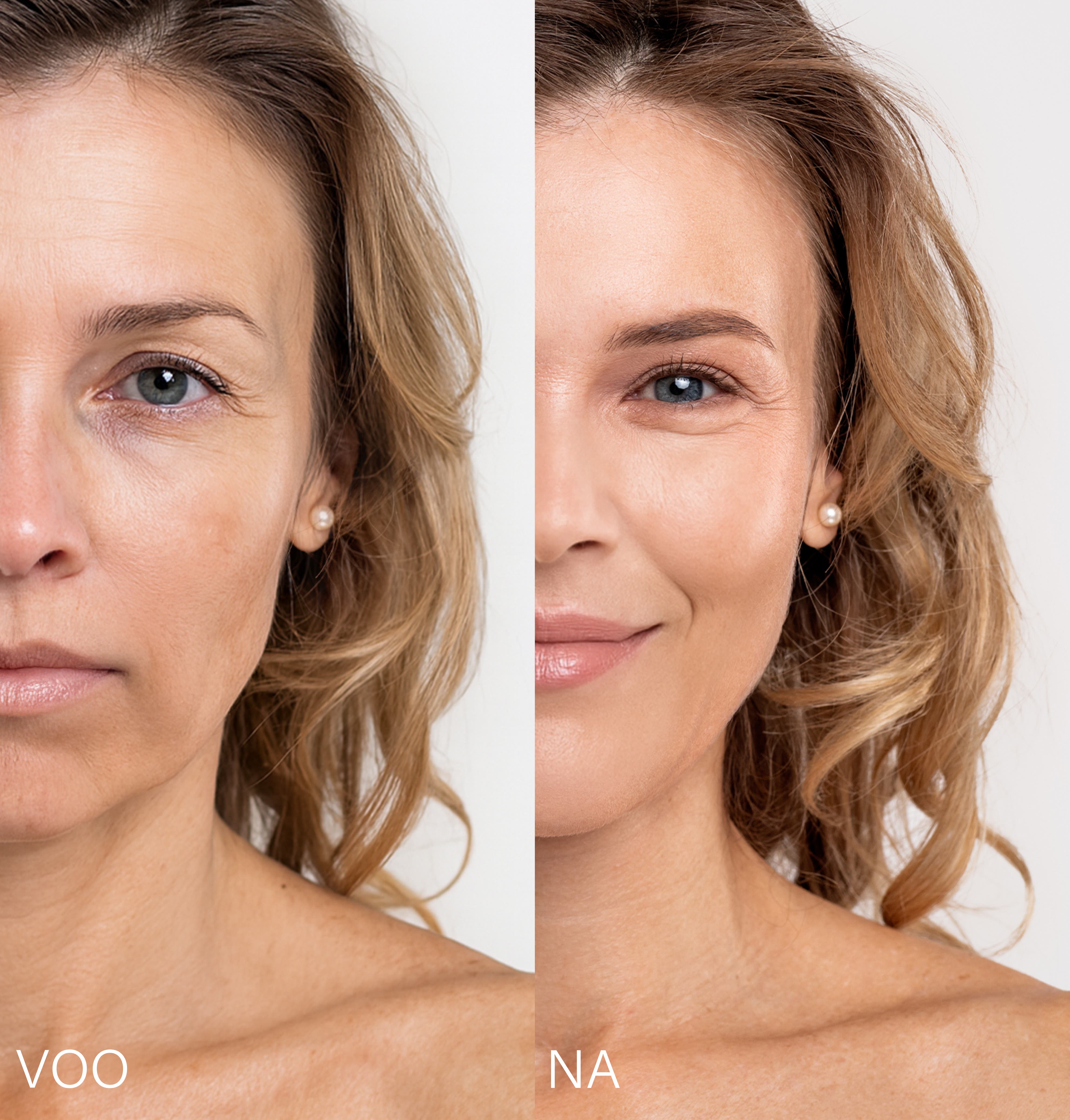 Microneedling Lifting Effect Duo