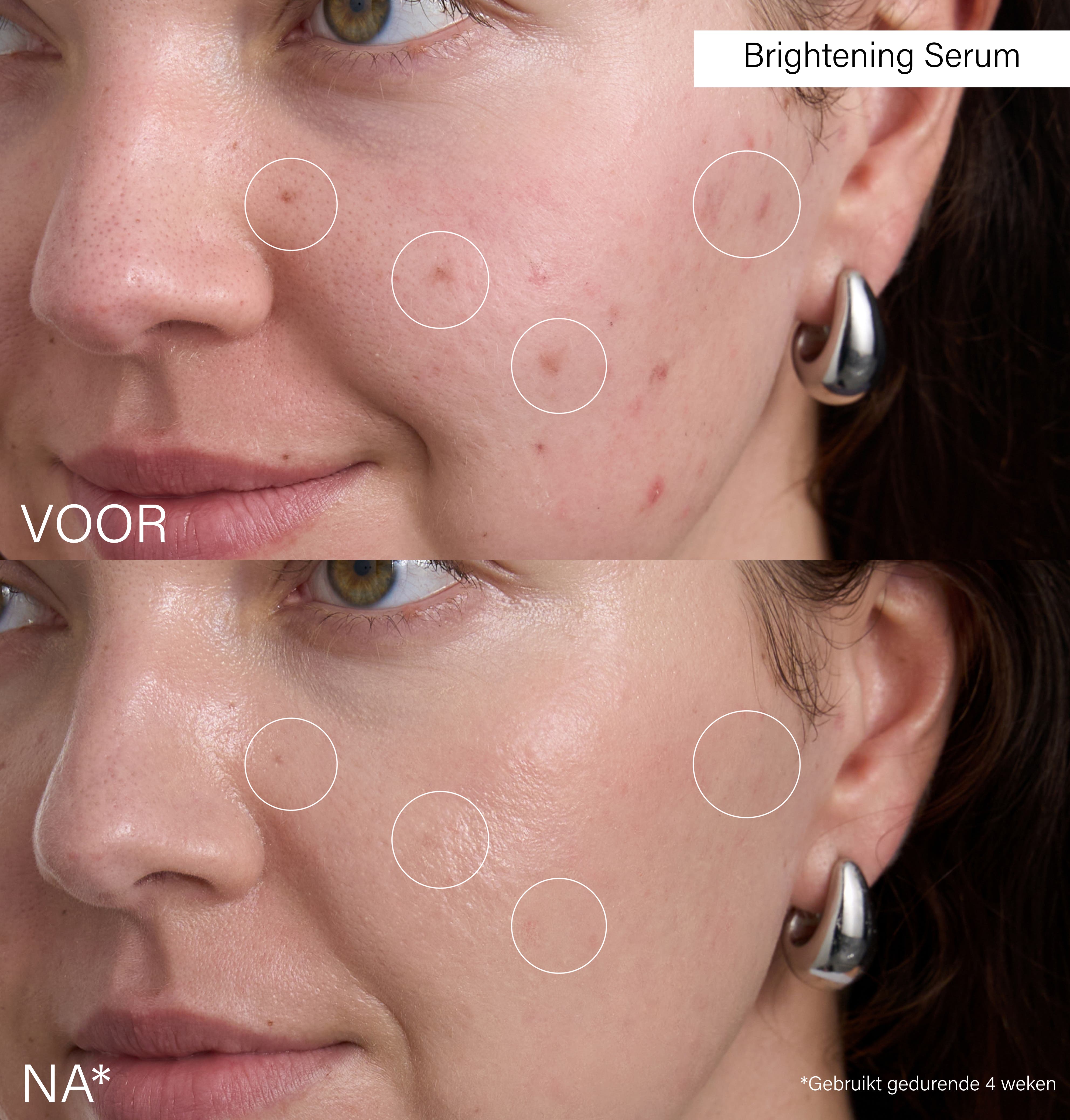 Anti-Hyperpigmentation Set